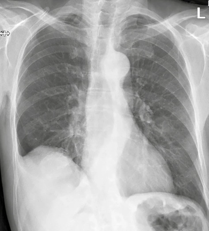 RTG plic s nálezem ostře ohraničeného stínu v dolním
plicním poli vpravo<br>
Fig. 1: Chest radiograph showing lobulated mass in the
lower zone of the right hemithorax