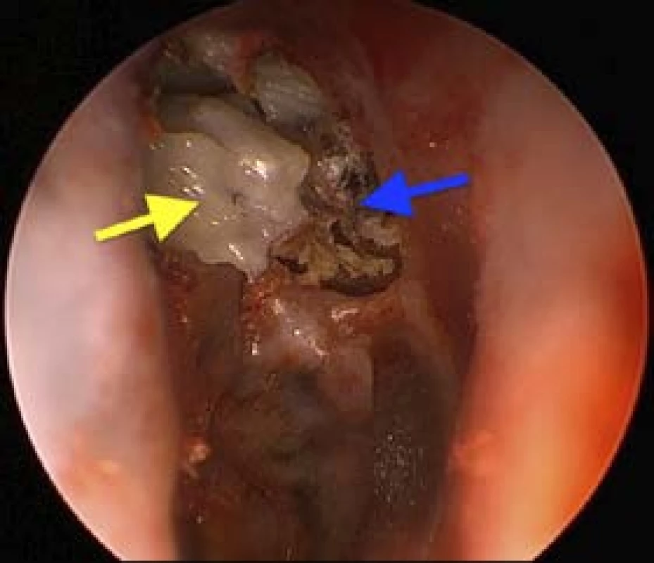 Endoskopický pohled: pravé ucho, žena, 60 let, v oblasti
epitympana hluboká nepřehledná retrakce s cholesteatomem
(žlutá šipka) a krustami cerumina (modrá šipka)
