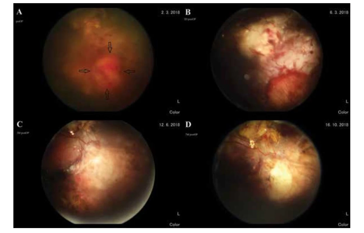Dolná temporálna periféria sietnice. (A) pred operáciou – tumor (čierne šípky), (B) 2 dni po operácii (okraje
retinektómie ošetrené endolaserom a kryoretinopexiou), (C) 3 mesiace po operácii, (D) 7 mesiacov po operácii