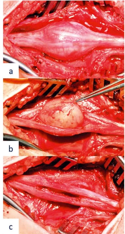 Peroperative image of the median nerve schwannoma resection –
(a) fascicle course on the surface of the tumour preceding tumour resection,
(b) microsurgical tumour resection, and (c) preserved neural structures following
radical tumour resection