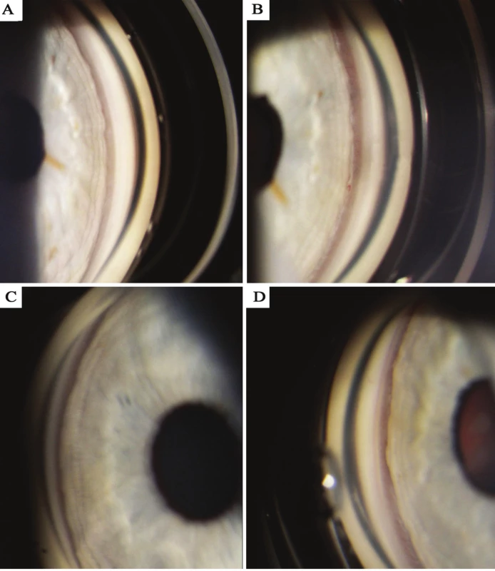 Gonioscophy photograph – documentation of configuration of chamber angle, A) right eye before discontinuation of trazodone, B)
right eye after discontinuation of trazodone, C) left eye before discontinuation of trazodone, D) left eye after discontinuation of trazodone.