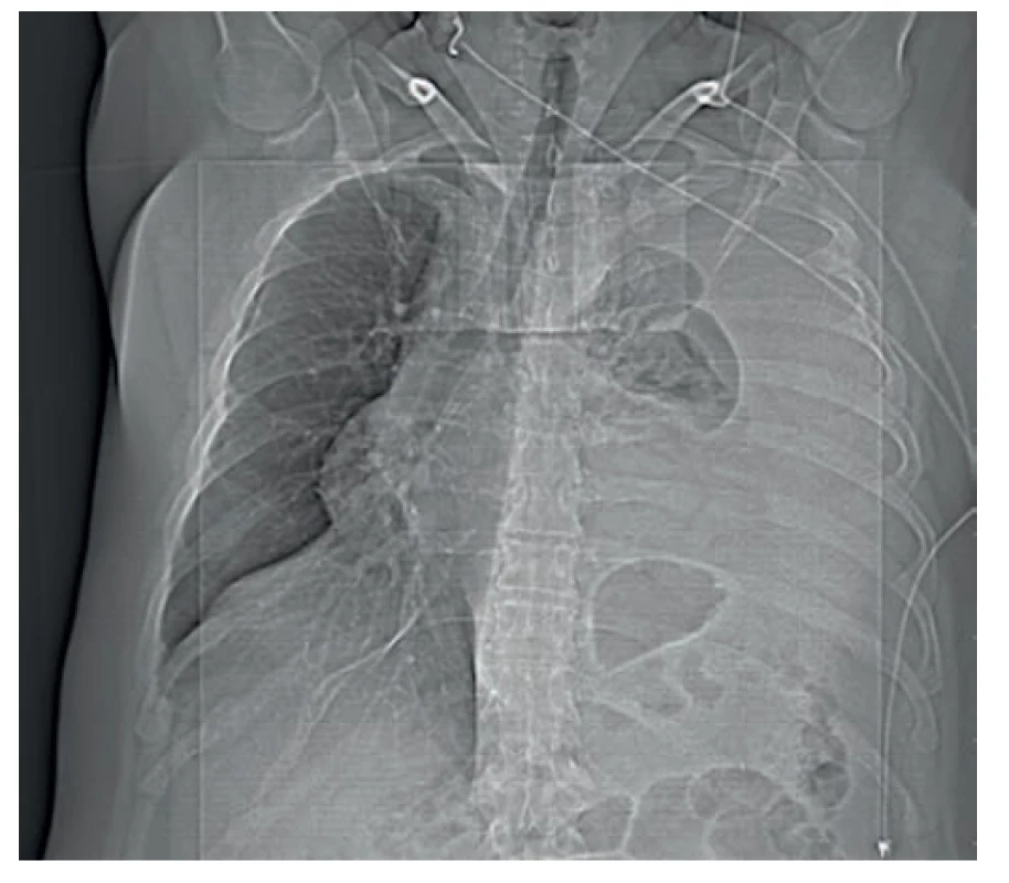 Iniciálny RTG obraz s pretlakom mediastinálnych
štruktúr doprava<br>
Fig. 1. Initial chest X-ray with mediastinal shift to the right