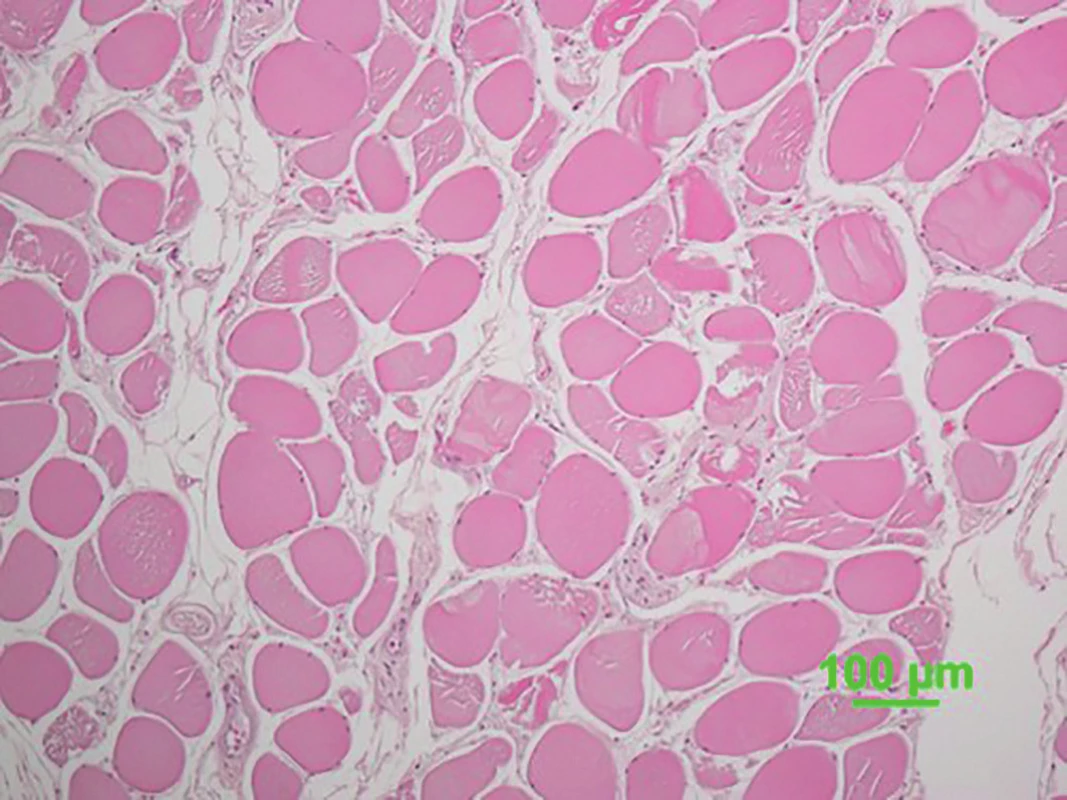 Hypercontracted fi ber in the skeletal muscle. (diaphragm, hematoxylin and eosin staining, objective lens ; 10).