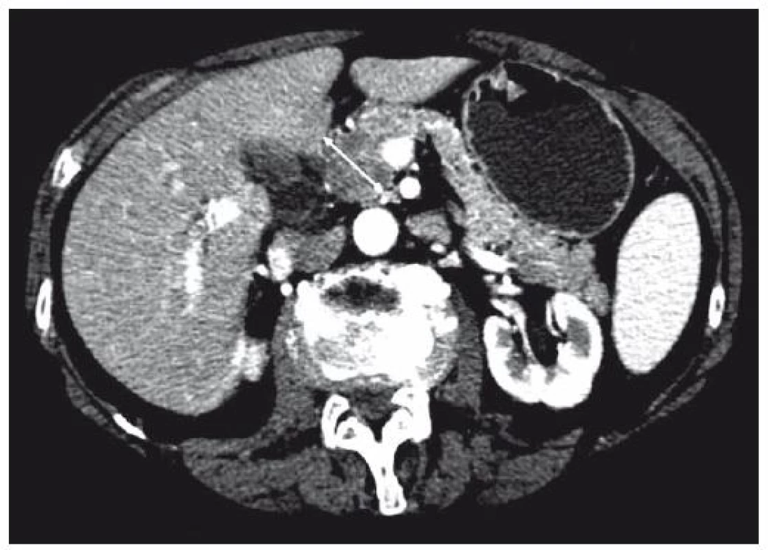 Axial contrast-enhanced CT image of an enlarged pancreatic head with heterogeneously dense mass.<br> Obr. 1. Axiální kontrastní CT snímek zvětšené hlavy pankreatu se smíšeně denzním ložiskem.
