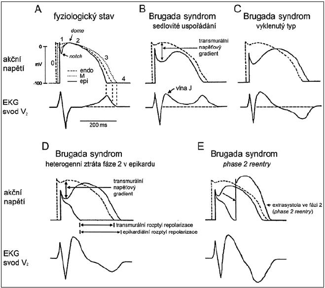 Brugada syndrom | proLékaře.cz