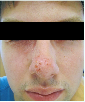 Exacerbace projevů atopické dermatitidy v obličeji