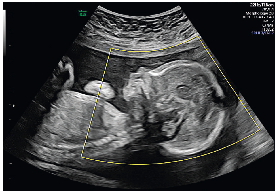 Impact Of 3d Ultrasound On Fetal Cns Examination Prolékařecz
