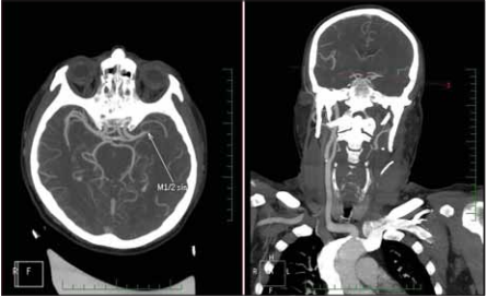 Carotid endarterectomy after intravenous thromboly... | proLékaře.cz